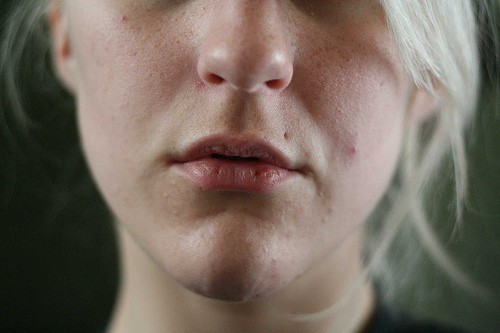 Sprode Rissige Lippen Hausmittel Gegen Trockene Lippen Hausmittelhexe