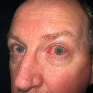 Rote Augen: Hausmittel gegen gerötete Augen
