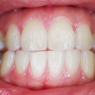 Zahnfleischschwund: Hausmittel gegen Parodontose / Parodontits